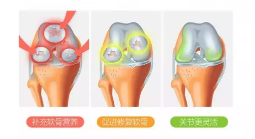 骨关节炎疼,不妨试试硫酸软骨素? 骨关节炎疼,不妨试试硫酸软骨素?