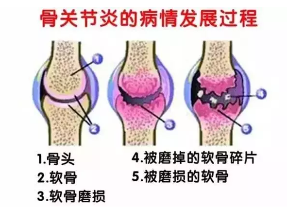 关节健康首选——硫酸软骨素 关节健康首选——硫酸软骨素