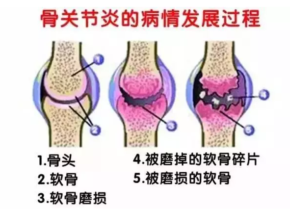 关节健康首选——硫酸软骨素