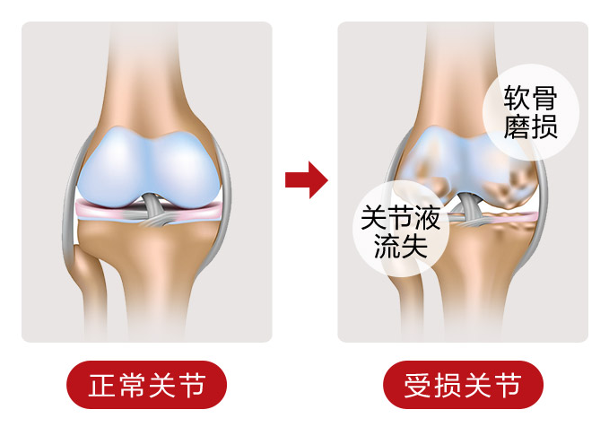 手指关节肿痛怎么治疗好一些？