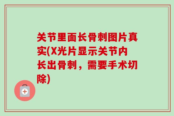 关节里面长骨刺图片真实(X光片显示关节内长出骨刺，需要手术切除)