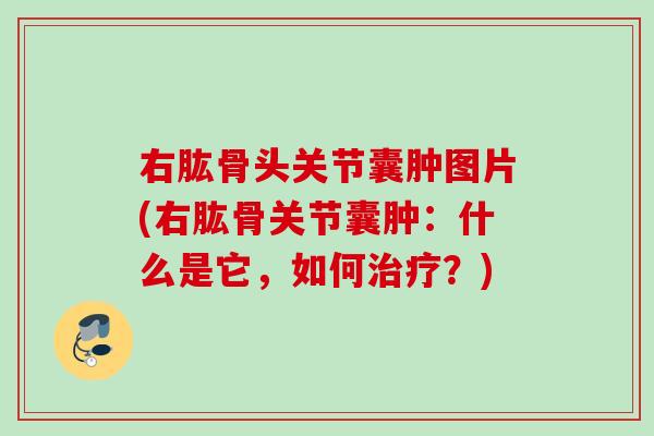 右肱骨头关节囊肿图片(右肱骨关节囊肿：什么是它，如何治疗？)