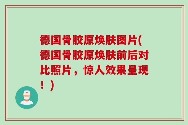德国骨胶原焕肤图片(德国骨胶原焕肤前后对比照片,惊人效果呈现!) 德国骨胶原焕肤图片(德国骨胶原焕肤前后对比照片,惊人效果呈现!)